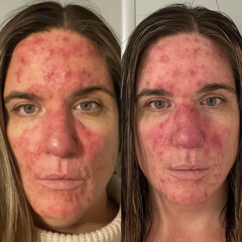 ACNE CARE